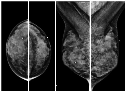 Mammogram dense breast tissue