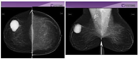 mammogram non-dense breast tissue
