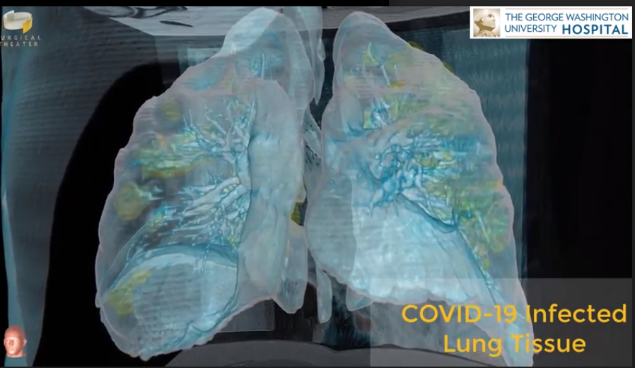 3D model of lungs highlighting damage from COVID-19